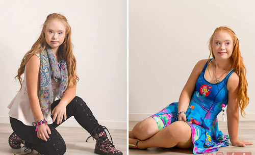 Cô gái bị down, mắt lé, miệng lệch, giảm 20kg thành người mẫu - 8