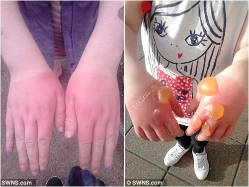 Ngò tây dại gây bỏng rộp, mù lòa nếu vô tình chạm phải - 3