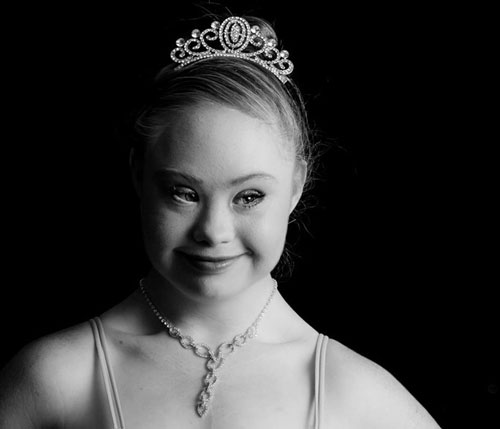 Cô gái bị down, mắt lé, miệng lệch, giảm 20kg thành người mẫu - 10