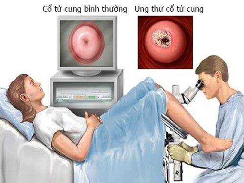 Những điều chị em cần biết về bệnh ung thư cổ tử cung - 1
